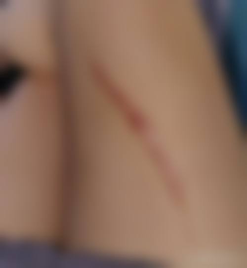 激光治疗皮肤愈合后的黑色疤痕成效能维持多久