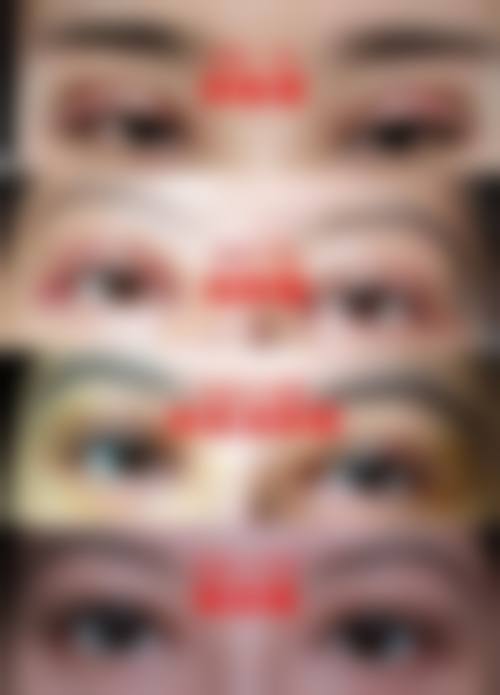 {做完眉弓多久可以做双眼皮？一般等1个月消肿后，不影响双眼皮形态