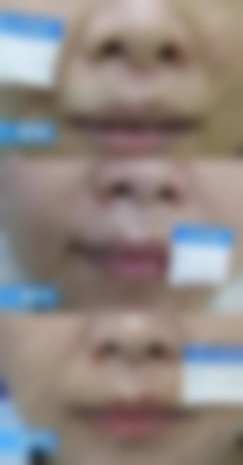 如何为用手挠的疤痕的发黑治疗设定一个合理且可验证的成效目标