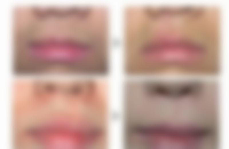 {用手挠的疤痕的发黑怎么办？医生揭秘5类药膏+2种激光疗法，2000-8000元告别黑色素沉着！