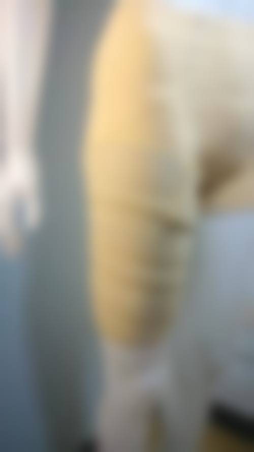 富贵包抽脂常见并发症或后遗问题，在临床中如何理解其发生概率