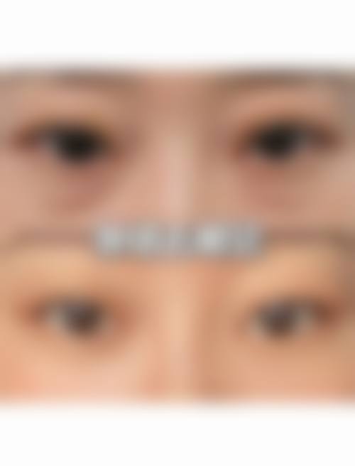 为什么眼袋会越来越大：不良生活习惯的持续影响