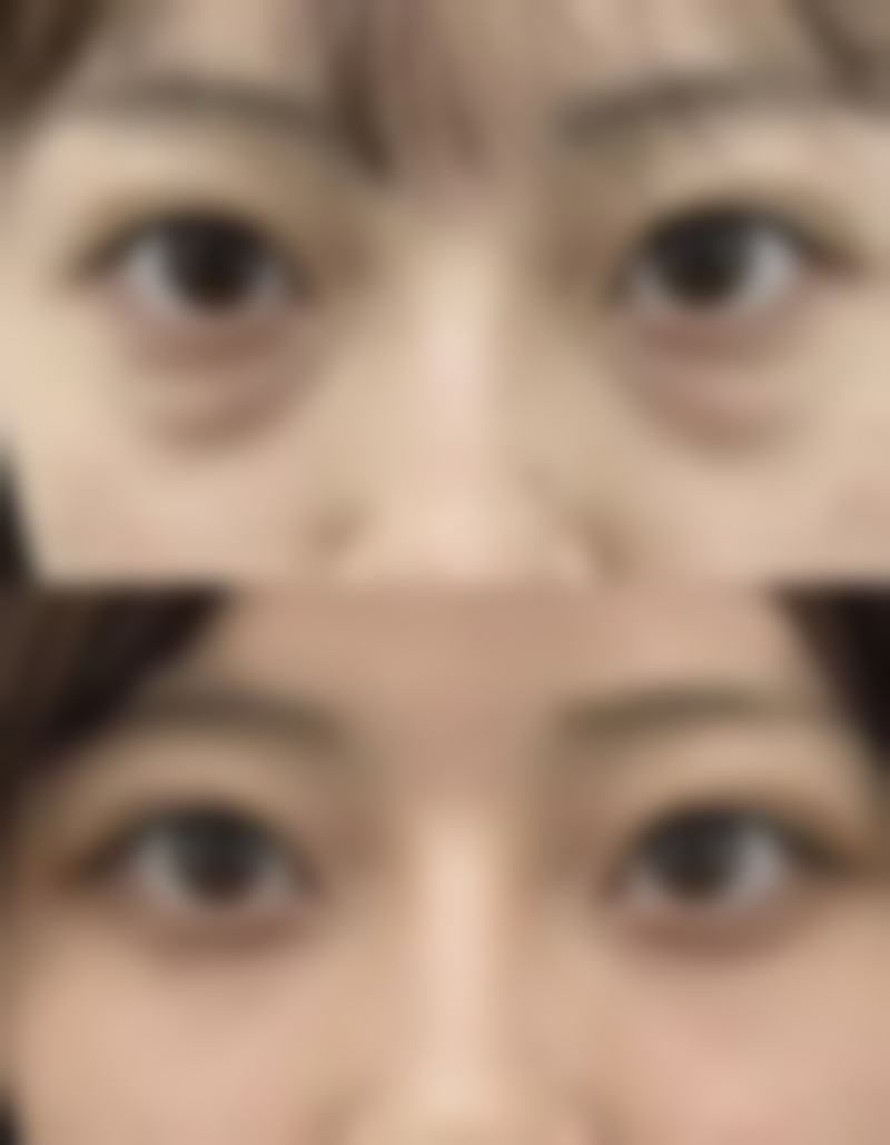 为什么眼袋重度需要专精评估