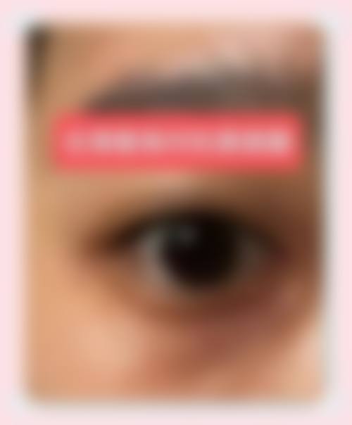 热敷眼睛对眼袋有作用吗