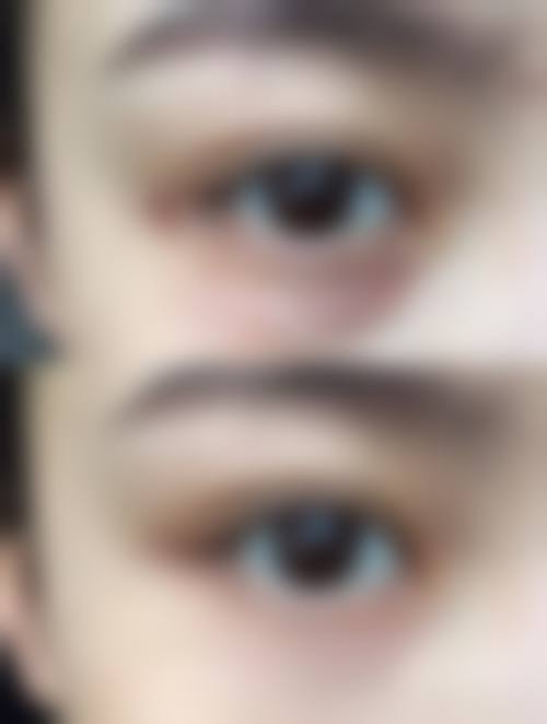 热敷对不同类型眼袋的成效差异