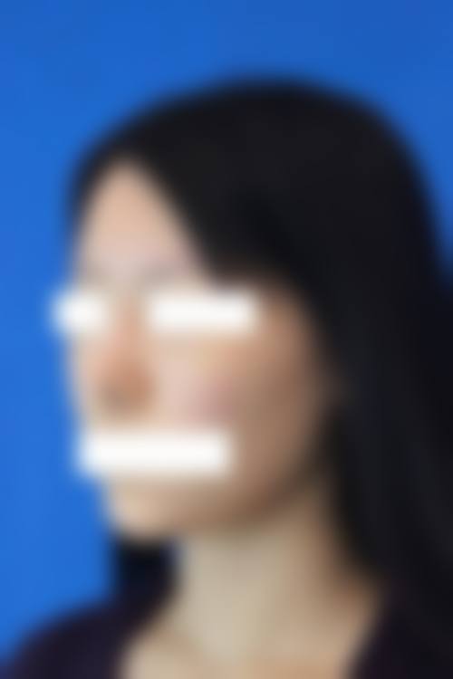 常见硅胶隆鼻“成效不明显”的真实原因有哪些