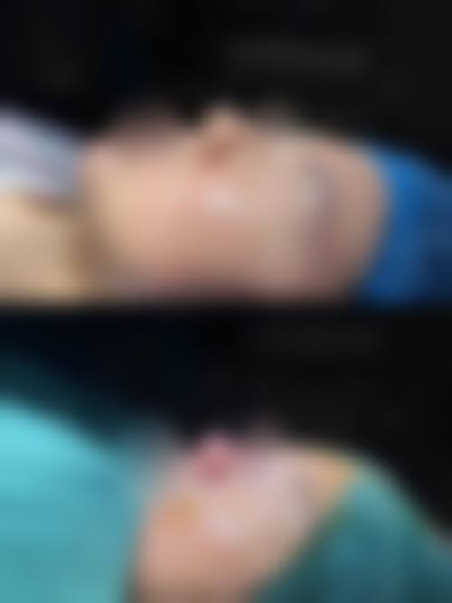 哪些部位或情况使用膨体隆鼻时成效相对更稳定