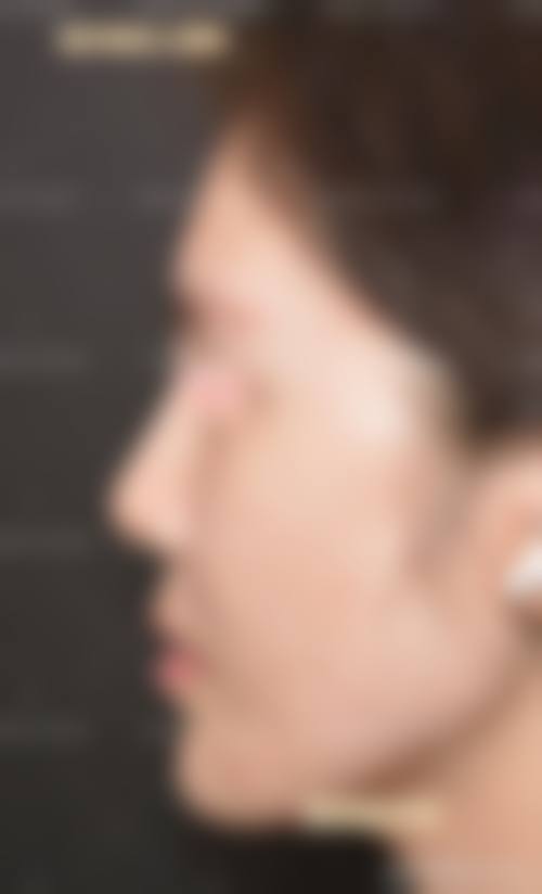 哪些使用场景下膨体隆鼻的成效往往不理想