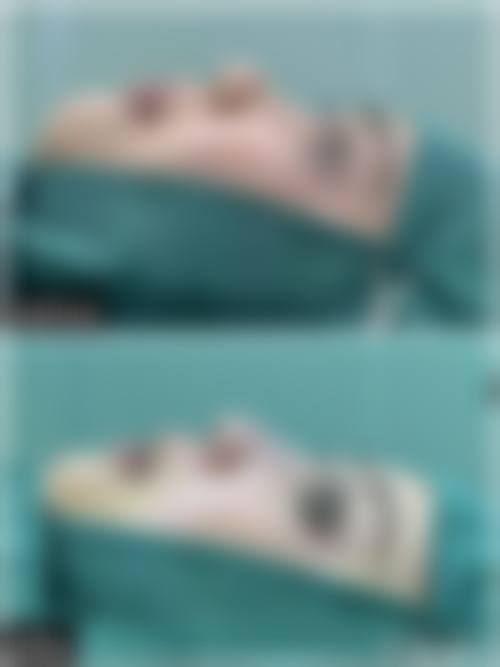 哪些使用场景下硅胶隆鼻的成效往往不理想