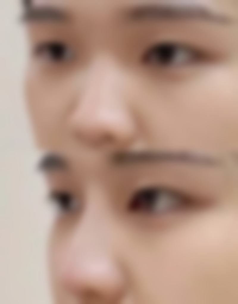 玻尿酸隆鼻有哪些优缺点?