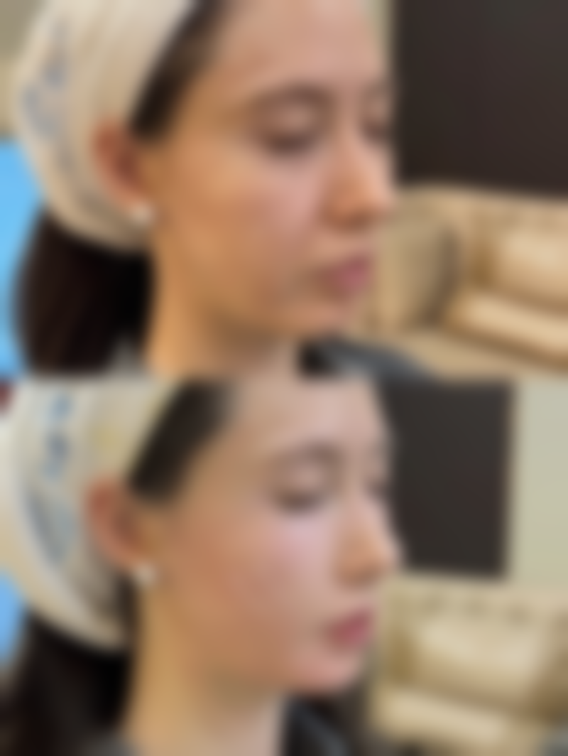 红电波拉皮除皱成效好吗？能维持多久