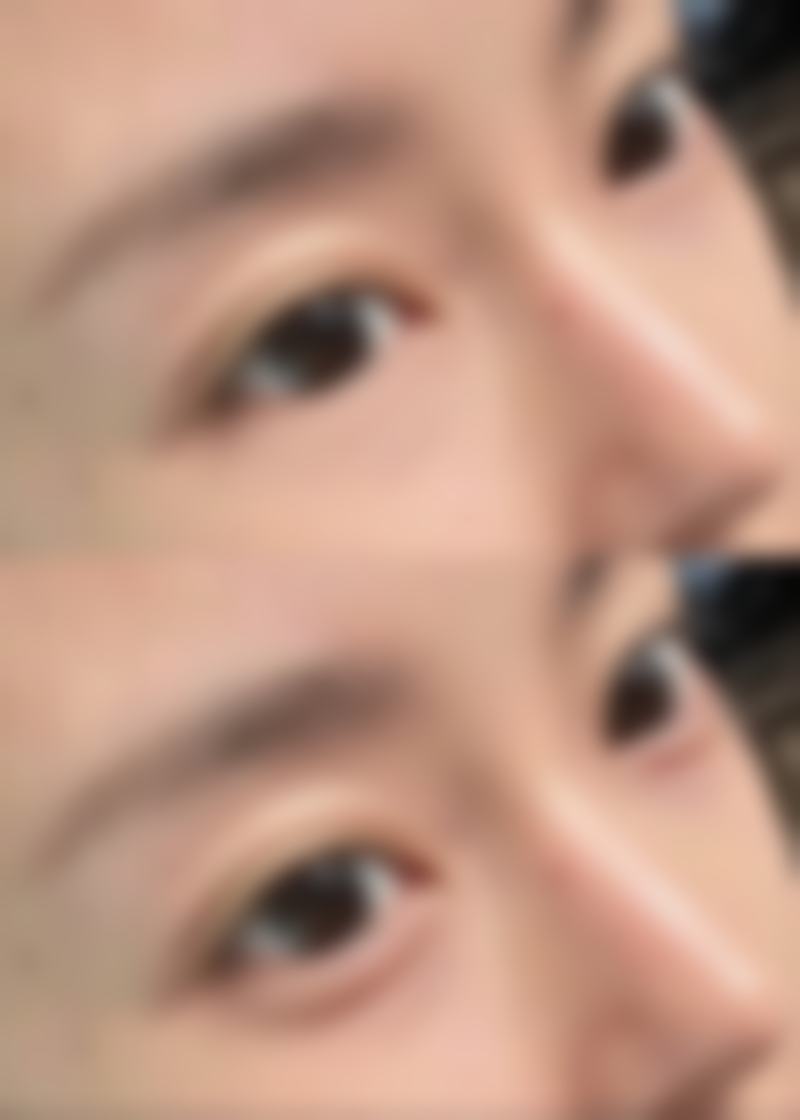 六、眼袋下面凹陷怎么修复饱满所依赖的技术 / 材料，现实优势与限制并存