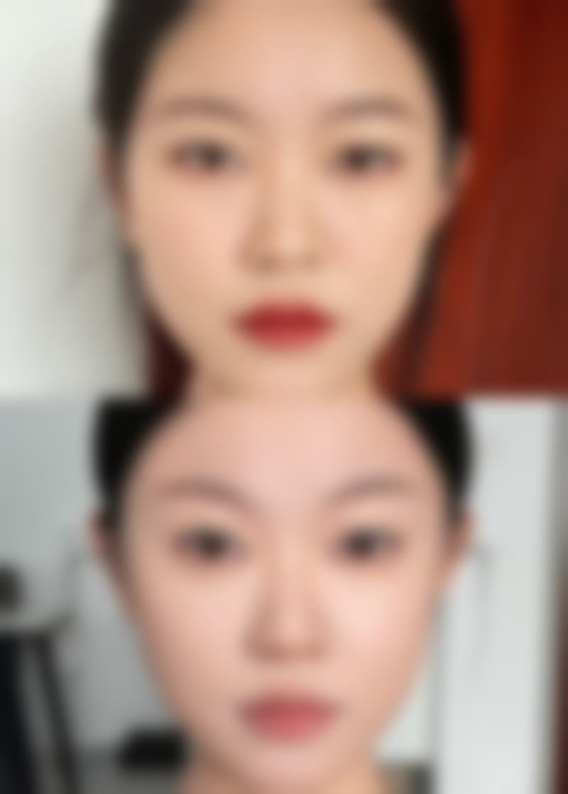 如何选择医院和医生，保护红电波拉皮除皱维持时间