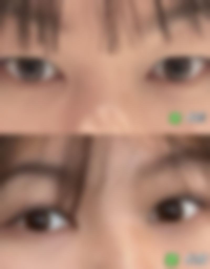 八、眼袋下面凹陷怎么修复饱满的成效稳定性取决于哪些因素？