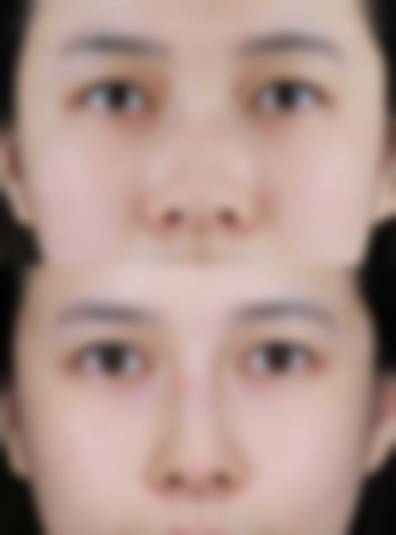 七、眼袋下面凹陷怎么修复饱满的费用为何差异明显？价格区间如何形成？