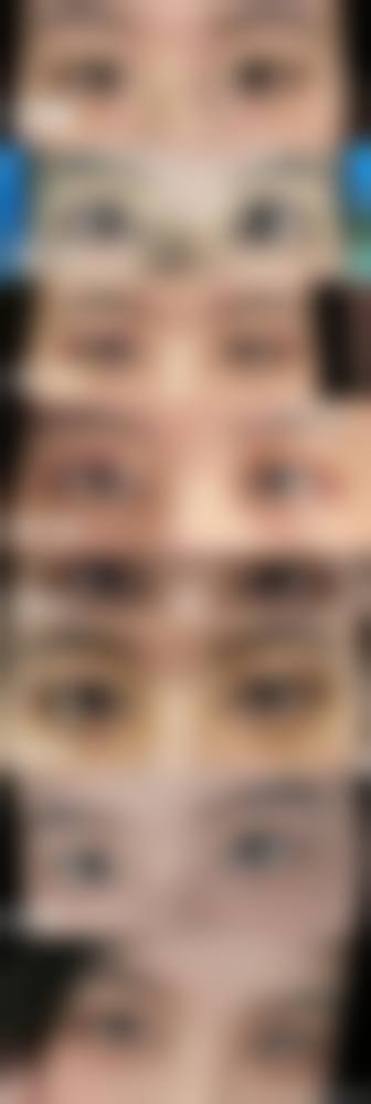 未成年割双眼皮有什么危害？避开这些风险才靠谱