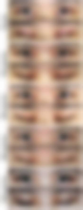 未成年割双眼皮需要家长签字吗？法规+风险双要求