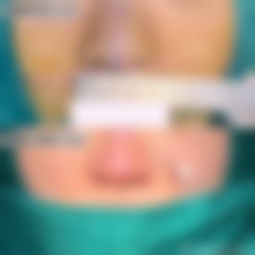 二、鼻子线提升隆鼻通常在什么阶段被纳入医疗选择范围？