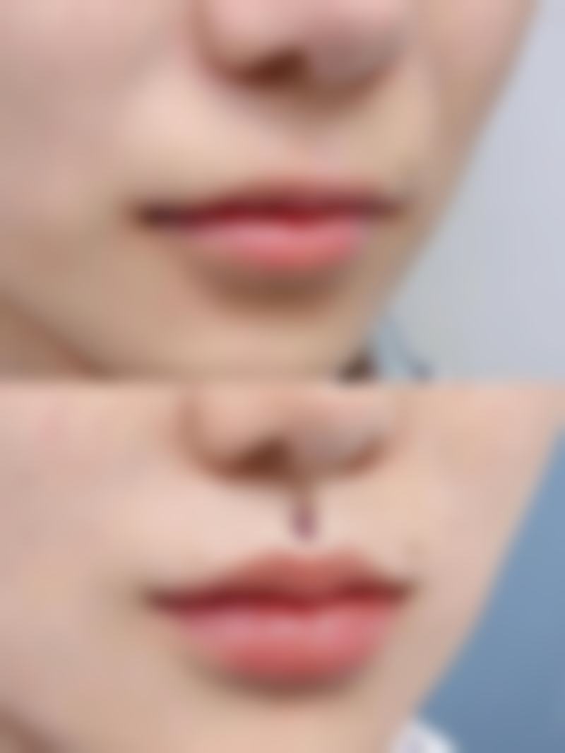 四、徐小辉医生的技术与典型操作流程