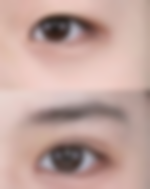 未成年割双眼皮会不会影响发育？选对时机特别关键