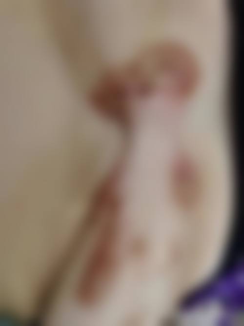 凝胶修复疤痕做决定前，普通用户更容易忽略的问题