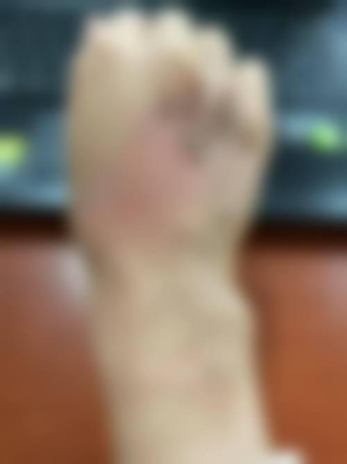 {凝胶修复疤痕有效果吗？硅酮凝胶3-6个月消红软疤，100-200元超实用