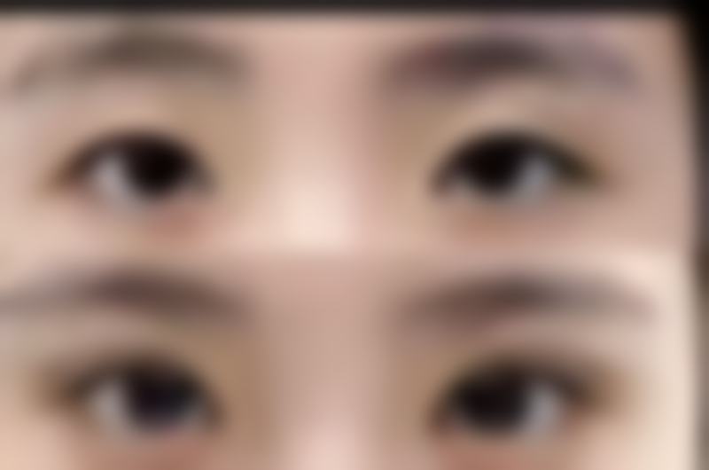 怎么判断我是否适合双眼皮手术项目？