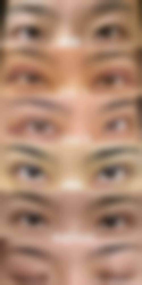 二、眼袋手术可以做第二次吗通常在什么阶段被纳入医疗选择范围？