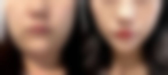 六、眼袋手术可以做第二次吗所依赖的技术，现实优势与限制并存