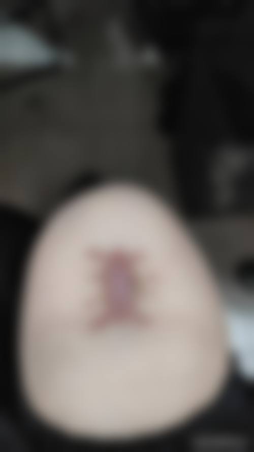 疤痕疙瘩增生的物理治疗方法