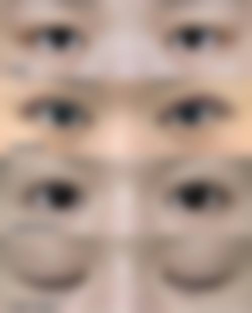 怎么判断我是否适合非手术去眼袋项目?