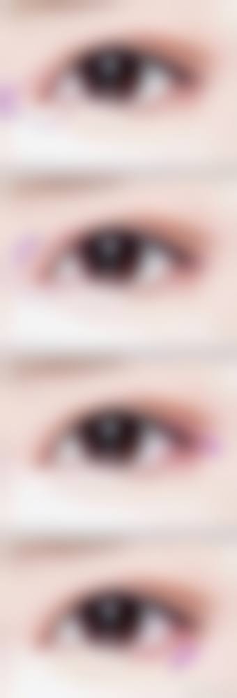 非手术去眼袋怎么选择医院医生及国内医院医生推荐?