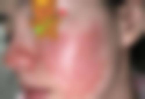 {点阵对凹陷疤痕有效果吗？有！3-5次改善表皮型凹疤，恢复期4-6周，附成功案例