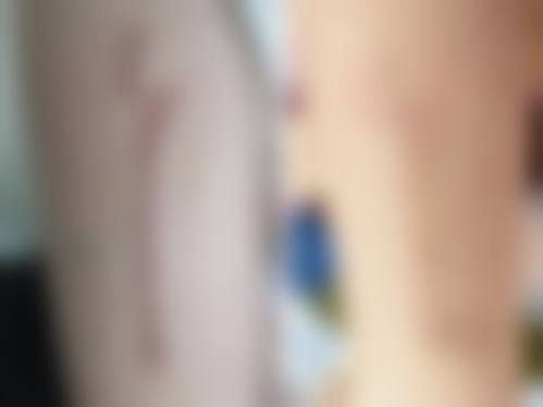 五、西安泓芝整形医院真实实例参考