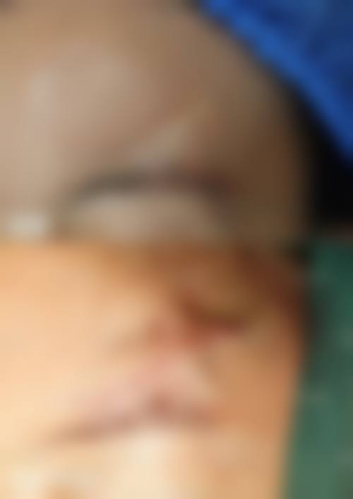 疤痕皮肤脱色变白的常见成因