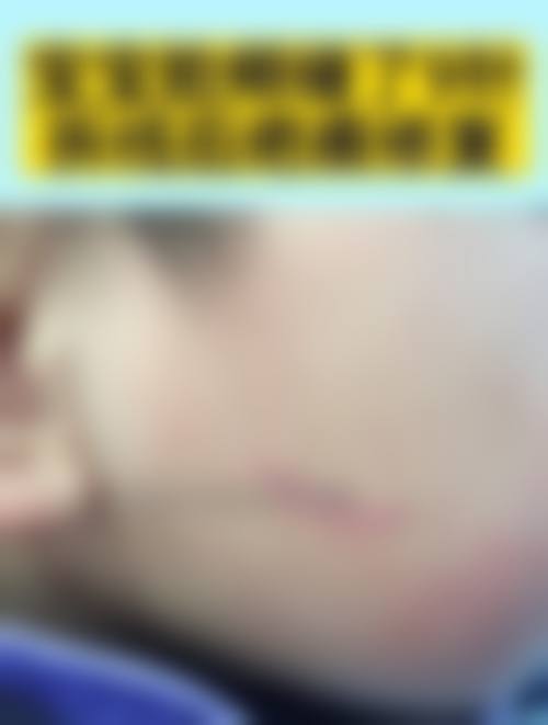 去除疤痕增生的价格