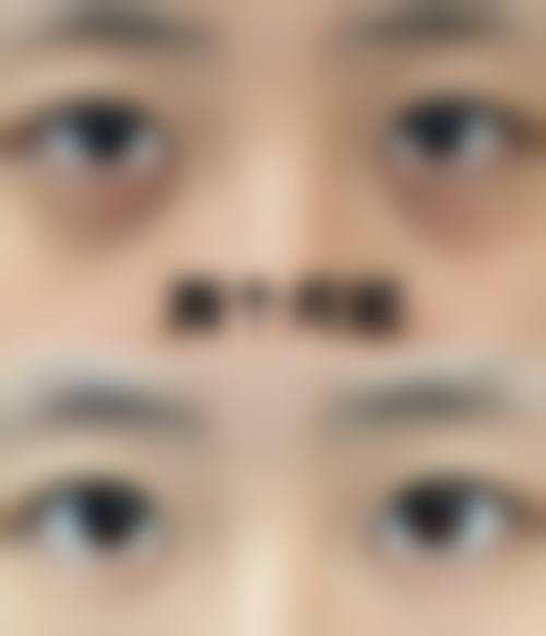 手术矫正方案：中重度眼袋的终极解决办法