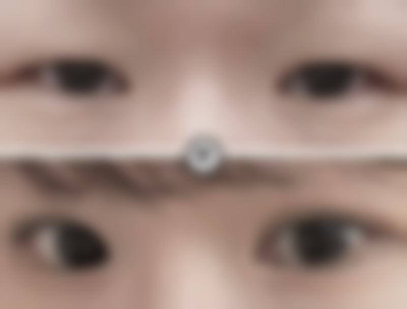 非手术改善方案：轻度眼袋松弛的救星