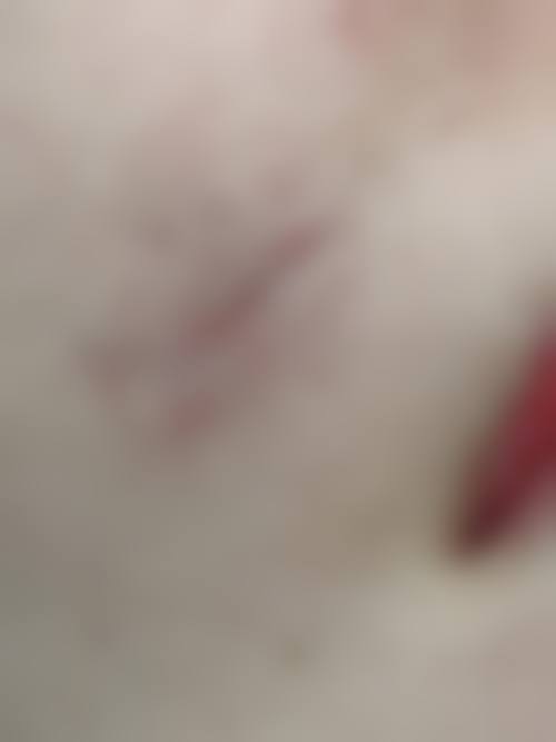 疤痕增生这样防更有效，拆线后如何除疤痕增生