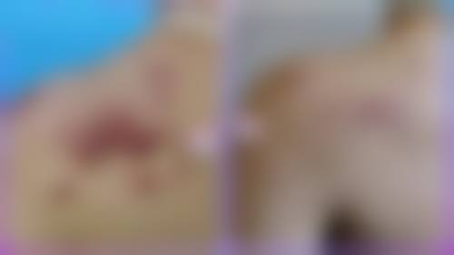 二十多年的疤痕激光能去掉吗之费用曝光