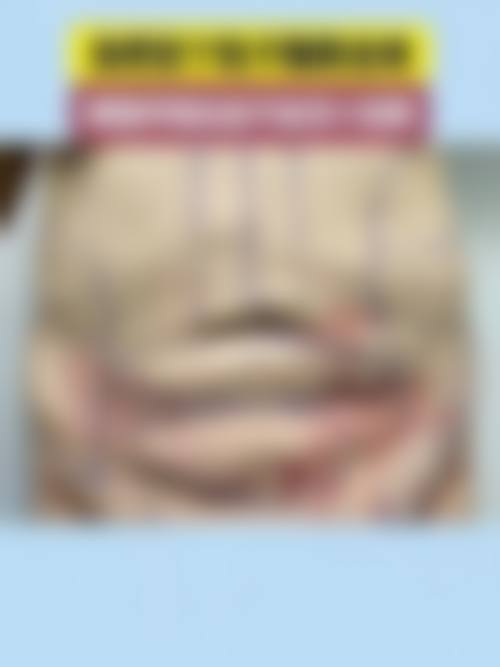 腰腹抽脂后，塑身衣越紧越好吗？