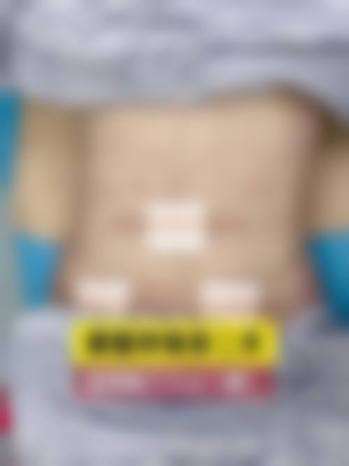 {腰腹抽脂后塑身衣要穿多久？医生：至少穿3-6个月！每天8-12小时，2月换小码，过紧易引发血运问题！