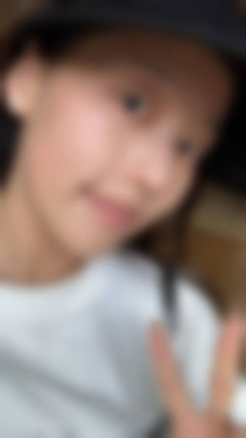 二十多年的疤痕激光能去掉吗之常用术式原理