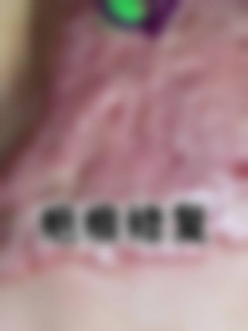 二十多年的疤痕激光能去掉吗之护理与注意事项