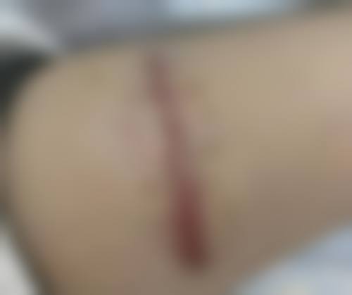 二十多年的疤痕激光能去掉吗之不同类型疤痕成效