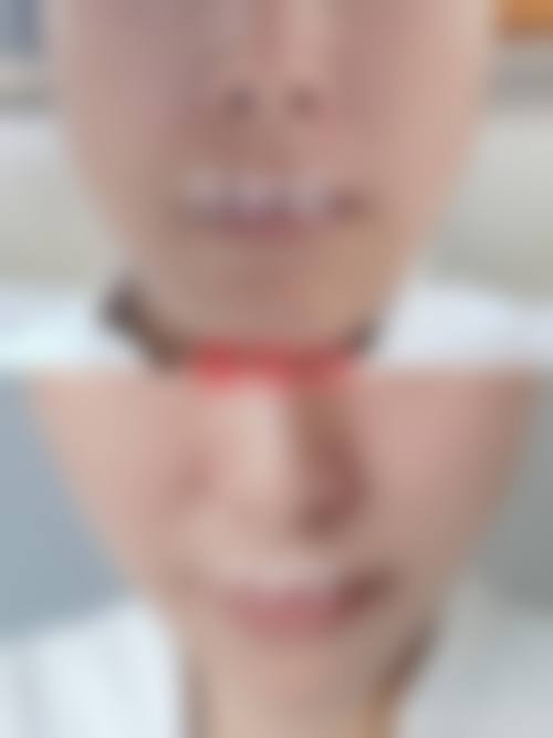 四、想让笑容快点变自然？这些护理妙招要记牢