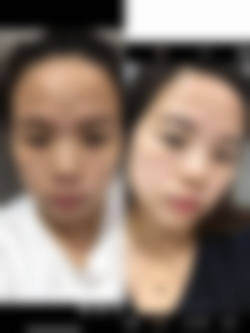 六、picoway超皮秒临床适应症及成效