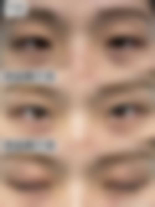 三、芦荟胶除眼袋的无效场景