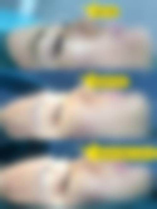 四、韩式双眼皮手术成效如何