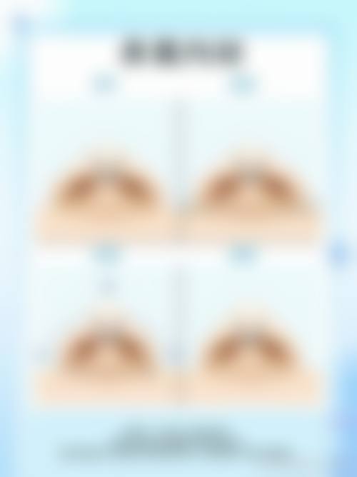 三、ADM填充鼻基底,真能减龄5岁吗?